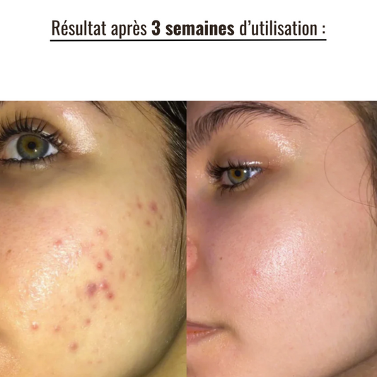Pack Peau Nette & Éclat